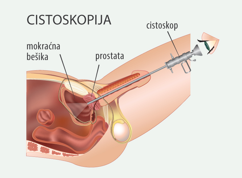 biopsija prostate cena novi sad standardele internaționale pentru tratamentul prostatitei