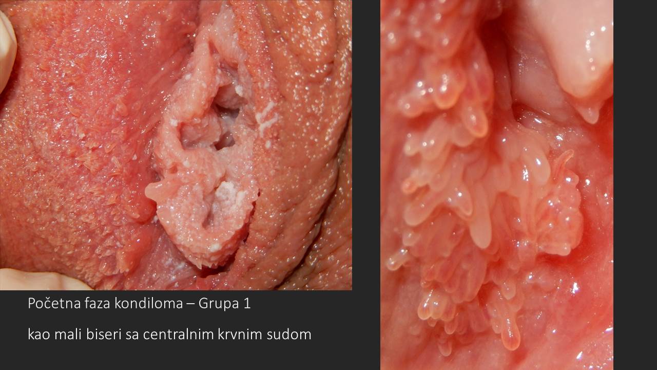 Početna forma perlastih kondiloma sa centralnim krvnim sudom na sluzokoži malih usana i ulazu u vaginu