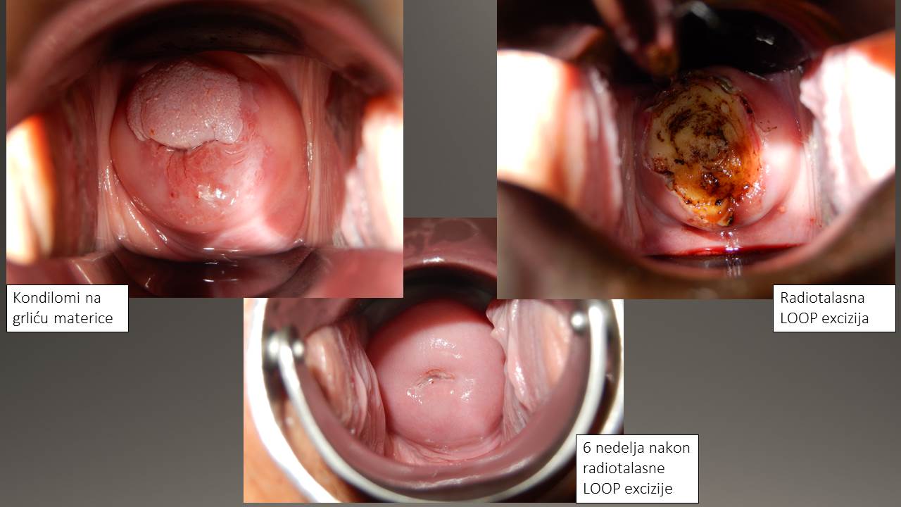 Normalan izgled grlića i malih usana sa ulazom u vaginu
