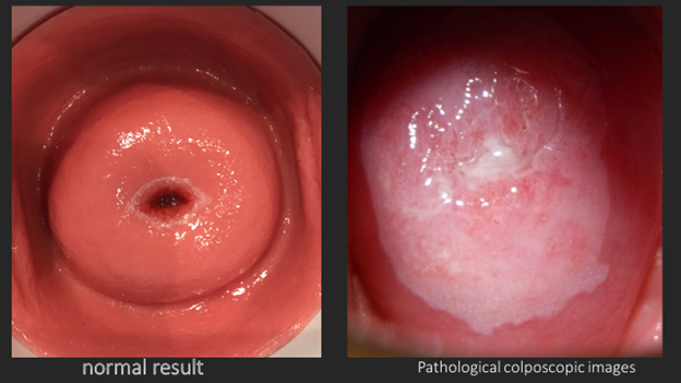 Normalan grlić- Patološka kolposkopka slika. HPV infekcija