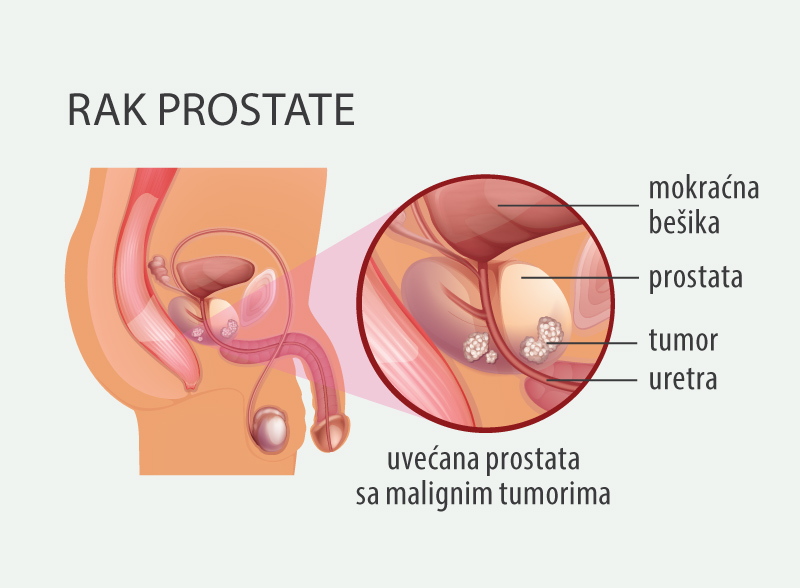 rak prostate
